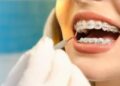 Do you wear braces? Here are 4 food items you should avoid