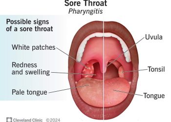 sore throat on one side