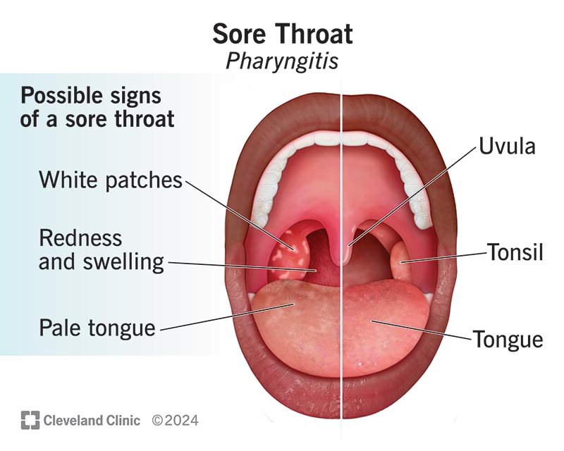 sore throat on one side